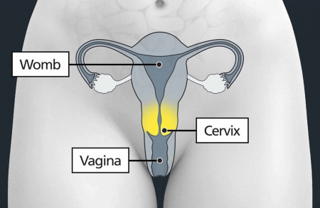 Cervical Screening 2.png